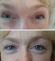 /album/fotogalerie/linky-pred-a-po-3-jpg/